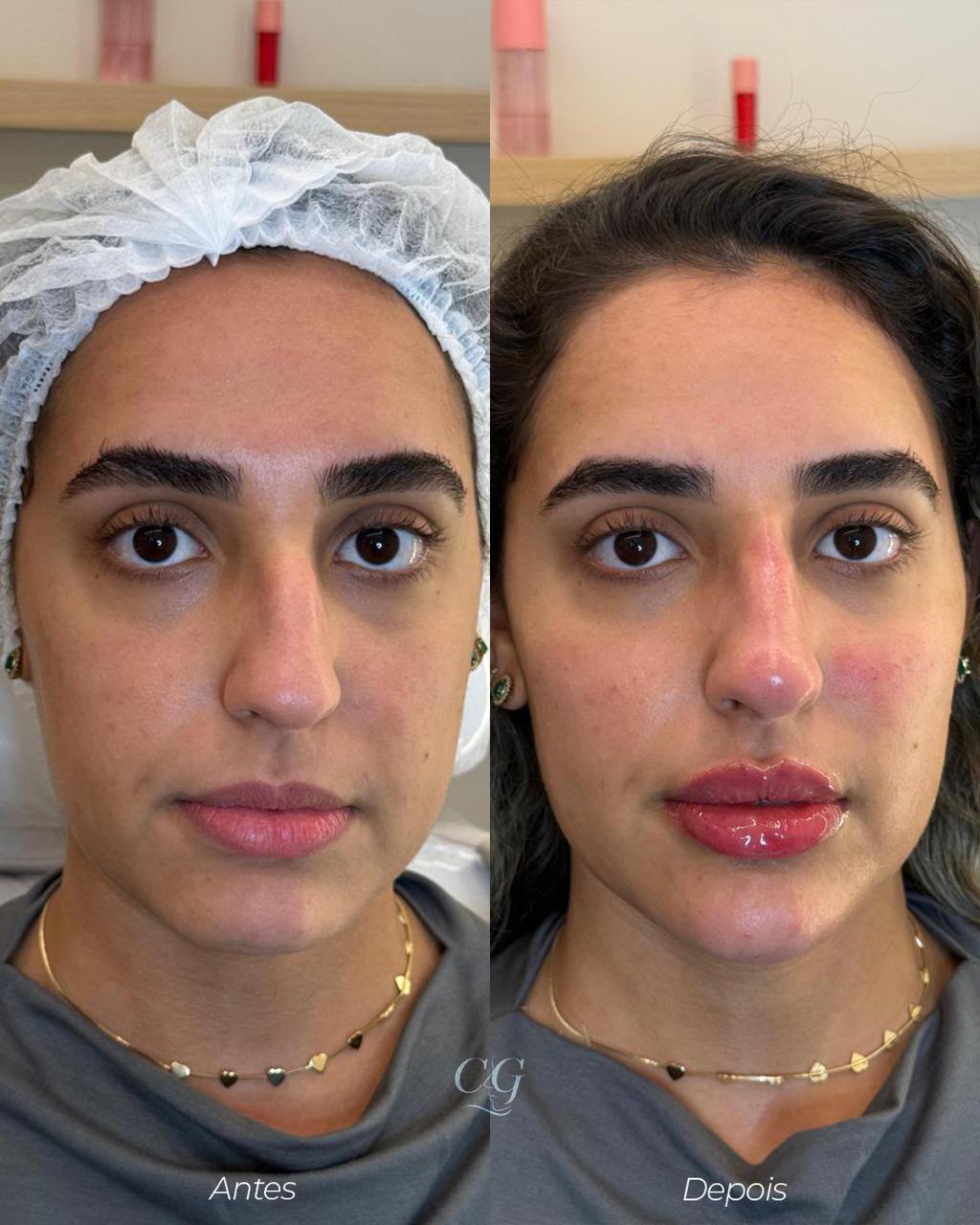 Comparativo de antes e depois de um procedimento de harmonização facial