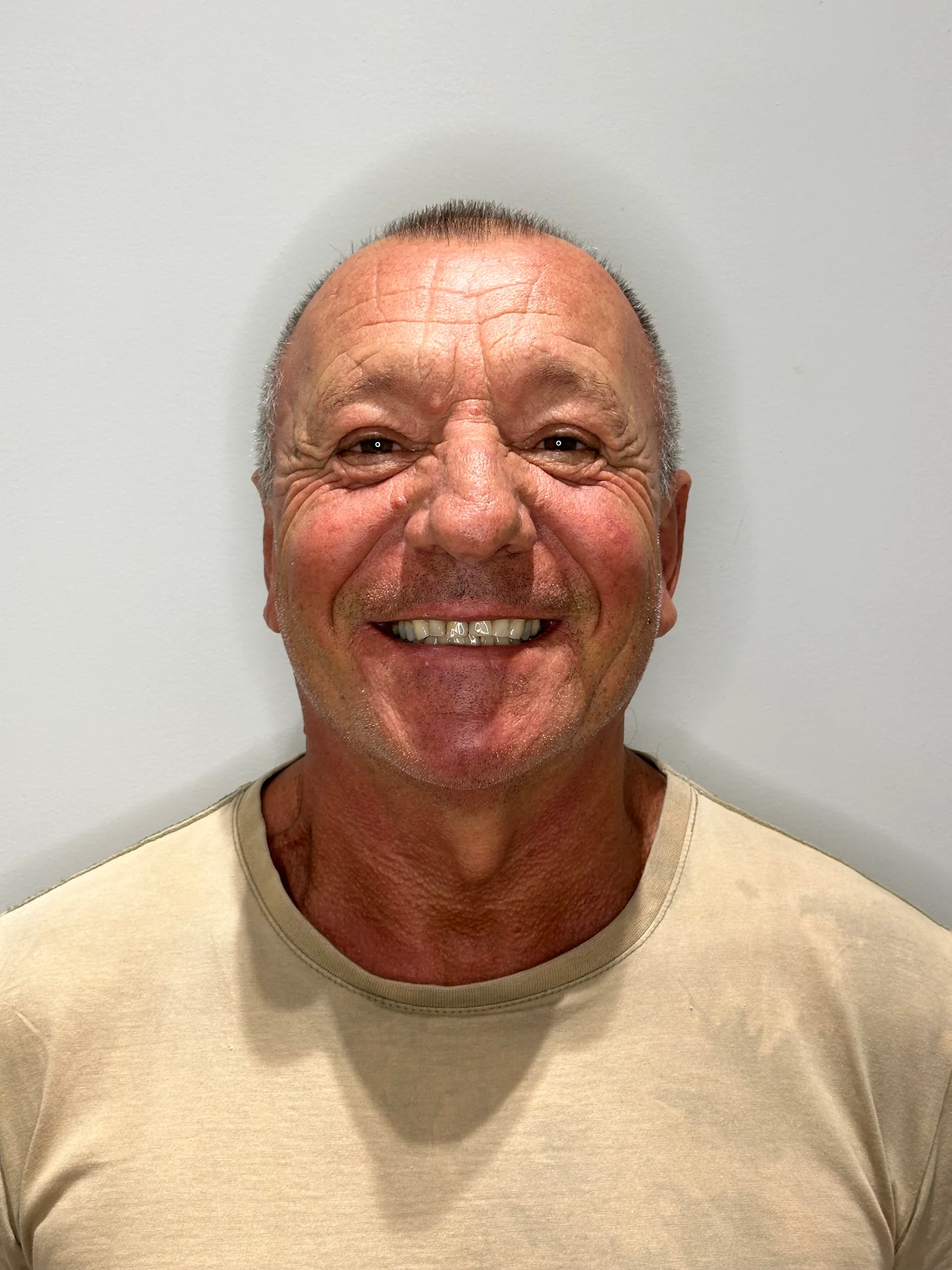 Sorriso do paciente antes da reabilitação odontológica