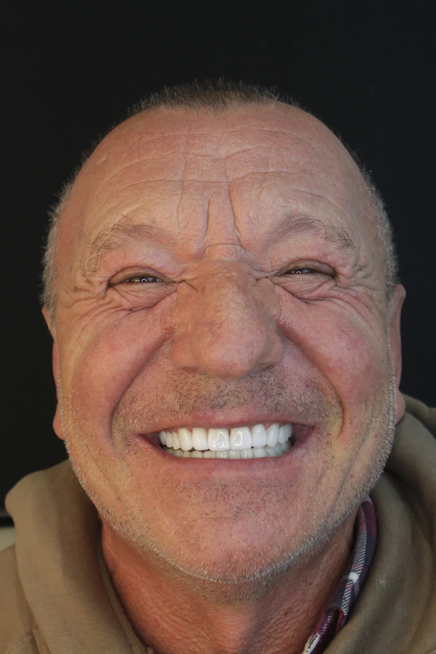 Sorriso do mesmo paciente depois da reabilitação odontológica